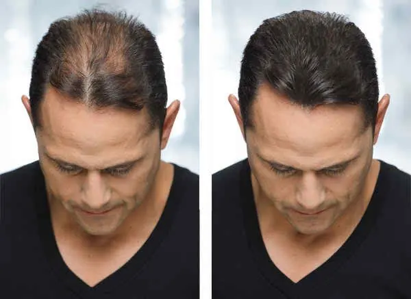 Meso Treatments